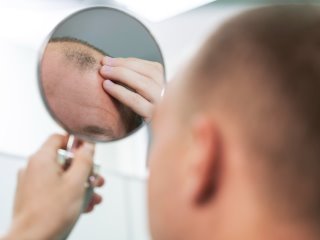 joven tiene alopecia areata y se mira en el espejo