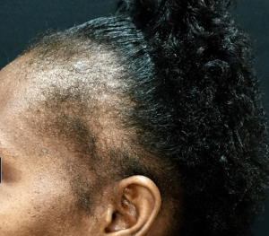 alopecia tradicional