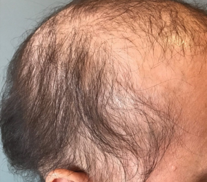 ALOPECIAS CICATRICIALES POST- QUIMIOTERAPIA