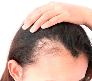 alopecia femenina