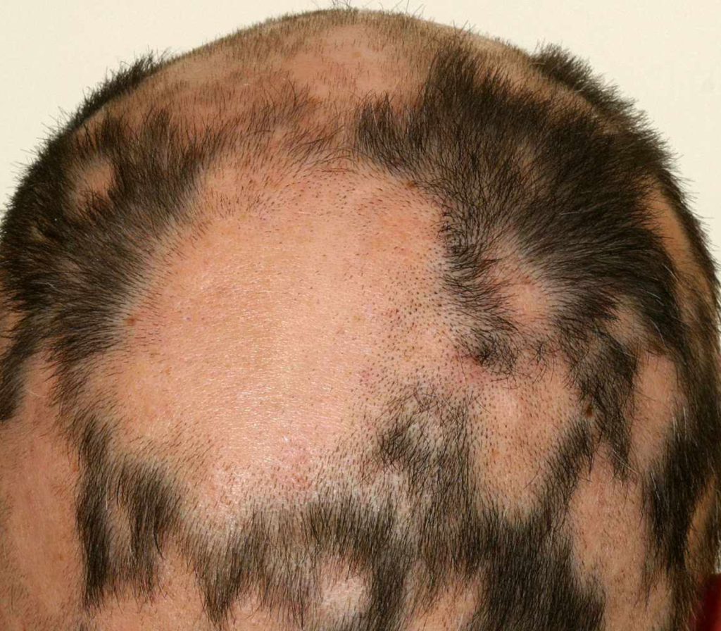 alopecia areata imagen de clínica del pelo