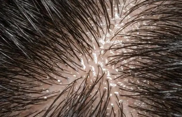 ¿Te suda la cabeza a lo bestia y el pelo se te queda “chafado”? Hiperhidrosis del cuero cabelludo: por qué puede empeorar la caída y cómo se trata