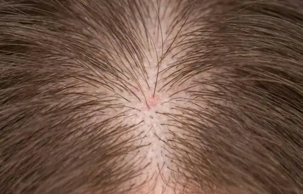 ¿Te duele el cuero cabelludo al tocarlo y no ves nada raro? Tricodinia y disestesia capilar: el síntoma “invisible” que puede estar frenando tu tratamiento