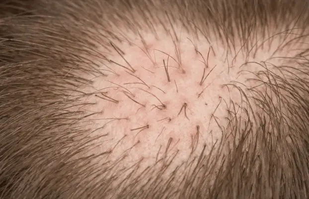 ¿Se te ha “borrado” pelo en una zona concreta y coincide con cómo duermes o con el casco? Alopecia por presión y fricción: el enemigo silencioso del cuero cabelludo