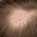 alopecia por presion