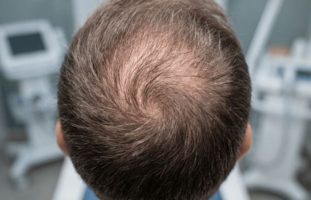 ¿Te preocupa tu coronilla? Señales que indican que podrías estar perdiendo densidad