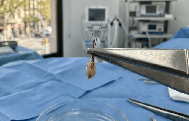 ¿Trasplante capilar con técnica FUE? Todo lo que no te cuentan antes de dar el paso