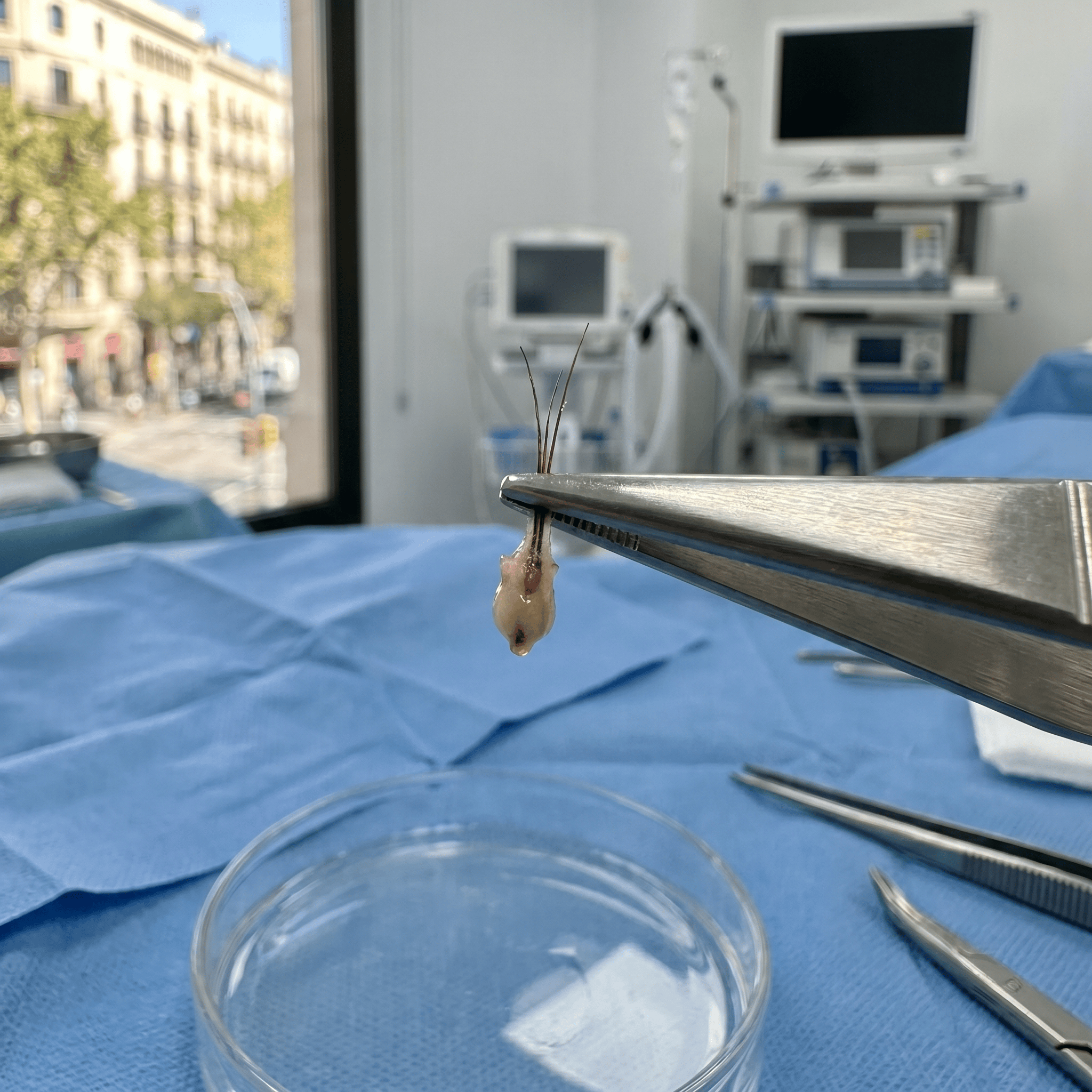 ¿Trasplante capilar con técnica FUE? Todo lo que no te cuentan antes de dar el paso